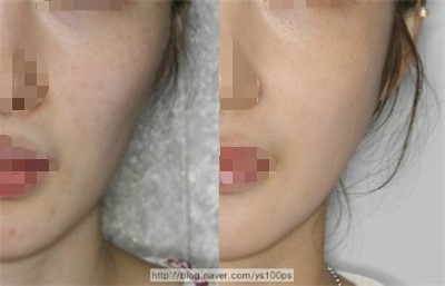 광대·사각턱수술 전후 볼 부위 변화를 보여주는 두 번째 증례