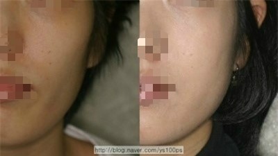 광대축소술 전후 볼륨 변화를 보여주는 첫 번째 증례