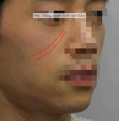 앞광대와 눈물고랑이 꺼진 수술 전 우측 사면 사진