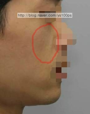 앞광대 볼륨이 부족한 수술 전 우측 측면 사진