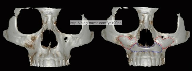 앞광대·귀족 부위 맞춤 보형물 수술 전후 정면 3D CT