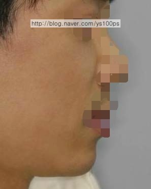 앞광대 보형물 수술 후 우측 측면 사진