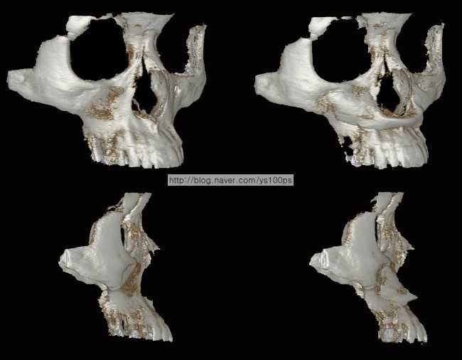 앞광대·귀족 부위 맞춤 보형물 수술 후 측면 3D CT