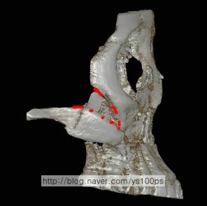 우측 광대 결손과 아치 골절 측면 3D CT