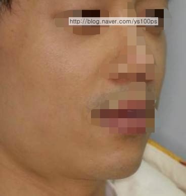 앞광대 보형물 수술 후 우측 사면 사진