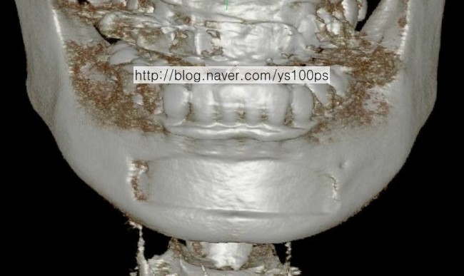 삽입 보형물 크기에 맞춰 함몰된 턱끝 3D CT
