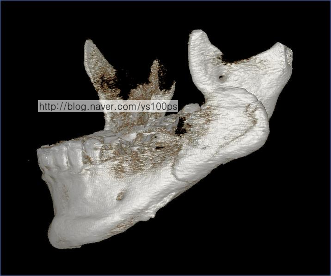 좌측 하악각 PMMA 재건 상태 사면 3D CT