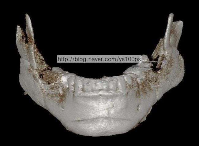 기존 PMMA 하악각 재건 상태를 보여주는 정면 3D CT