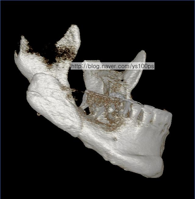 우측 하악각 PMMA 재건 상태 사면 3D CT