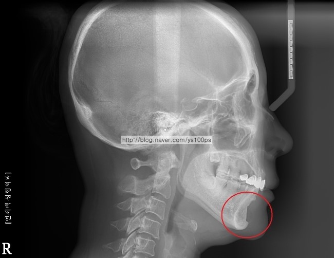 실리콘 턱끝 보형물 주변 뼈침식을 표시한 3D CT