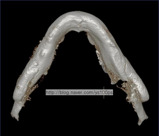 기존 PMMA 하악각 재건의 좌우 비대칭 아래쪽 3D CT