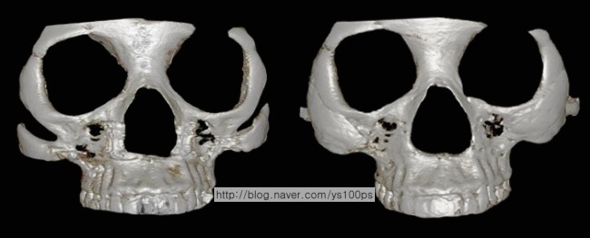 양측 광대갭을 3D Fit PMMA로 재건한 정면 3D CT