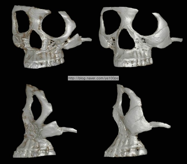좌측 광대갭을 재건한 측면·사면 3D CT