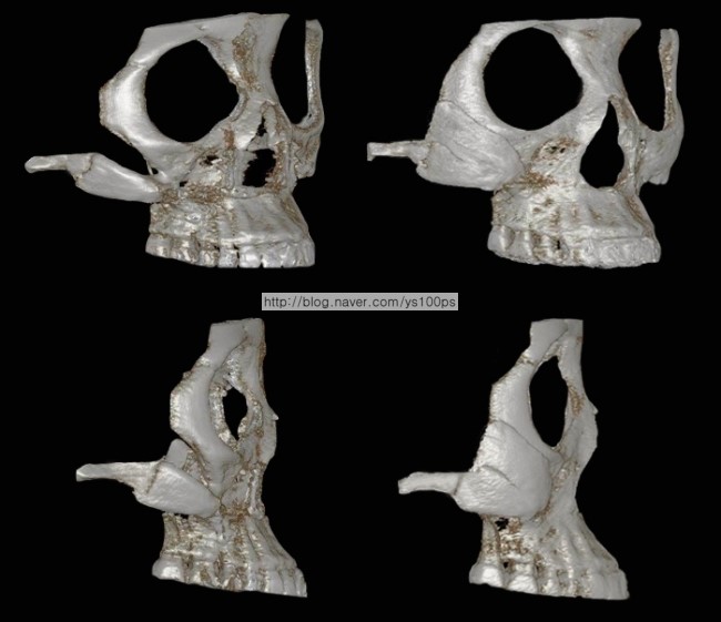 우측 광대갭을 재건한 측면·사면 3D CT