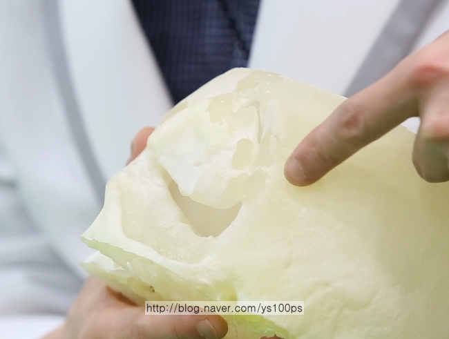 외상 또는 두개골수술 후 발생한 두개골 결손