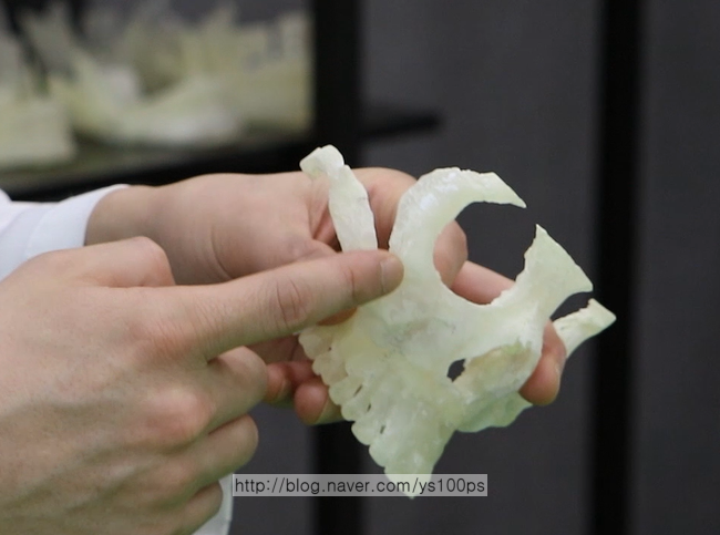 광대수술 후 불유합과 벌어짐이 발생한 3D CT