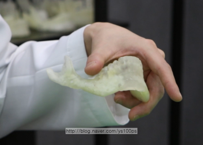 사각턱 과절제로 귀밑각이 사라진 하악골 3D CT