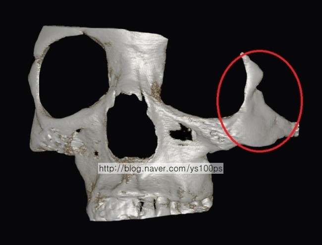 좌측 광대 함몰과 계단을 보여주는 사면 3D CT