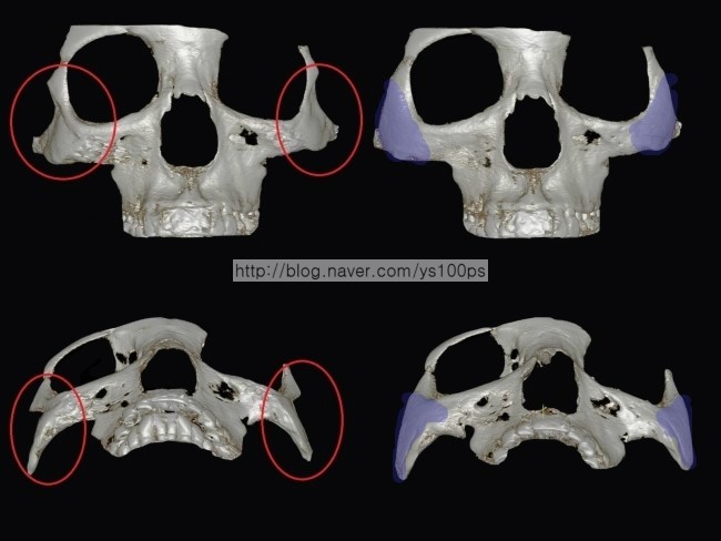 3D Fit PMMA 보형물로 광대 결손을 재건한 아래쪽 3D CT