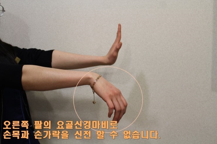 마비질환(안면마비,요골신경마비,비골신경마비)은 침, 봉침, 한약으로 손상된 신경을 치료하세요 : 네이버 블로그 마비질환(안면마비,요골신경마비,비골신경마비)은 침, 봉침, 한약으로 손상된 신경을 치료하세요 : 네이버 블로그