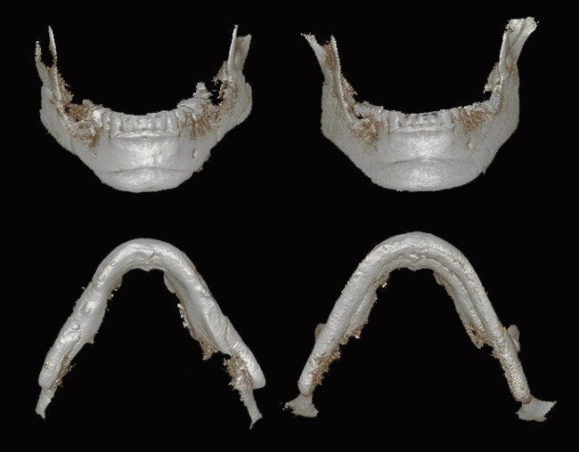 사각턱 재건 재수술 전후 정면 3D CT