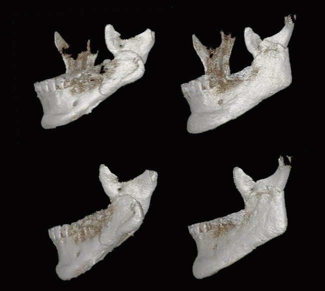 사각턱 재건 재수술 전후 좌측 3D CT