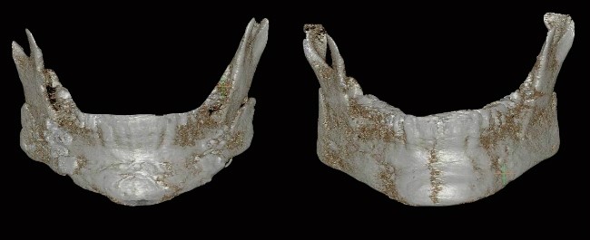기존 본시멘트 제거 전 하악골 3D CT