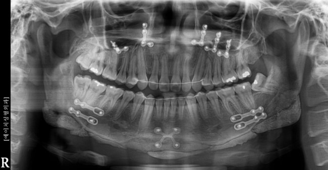 하악각과 턱끝의 본시멘트 및 금속 고정물 3D CT