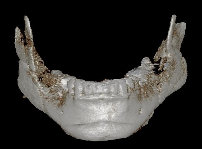 PMMA 제거 후 3D Fit 맞춤 재건 상태
