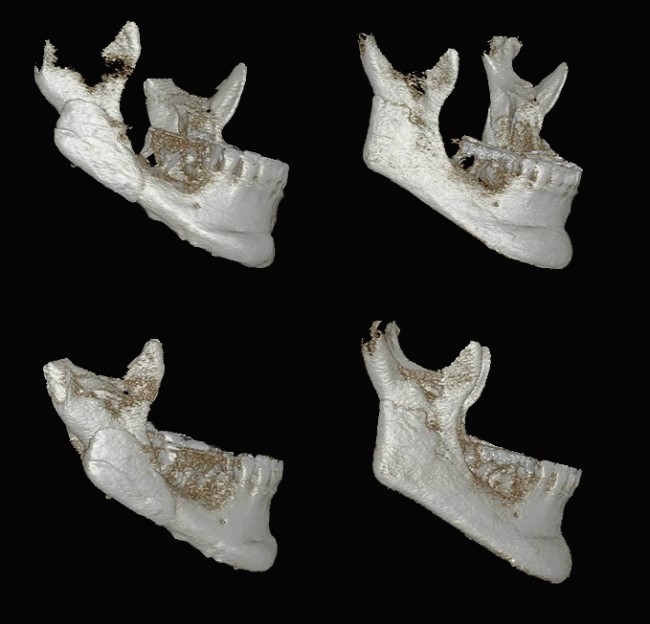 사각턱 재건 재수술 전후 우측 3D CT