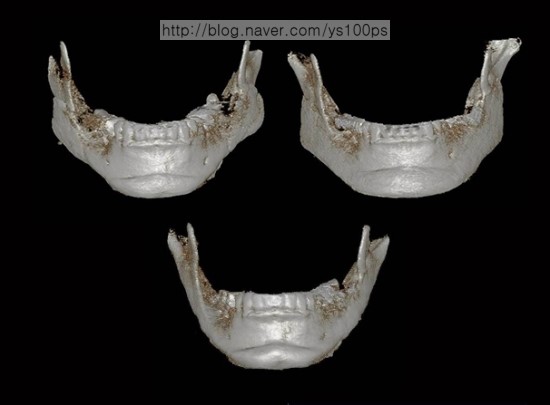 사각턱 재건 재수술 전후 아래쪽 3D CT