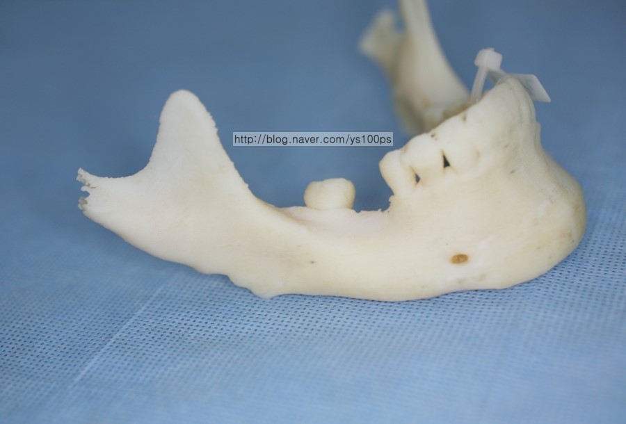 Stratasys Objet로 출력한 하악골 모형