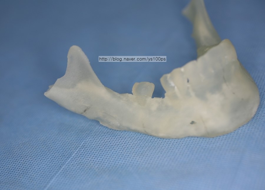 3D Systems ProJet로 출력한 하악골 모형