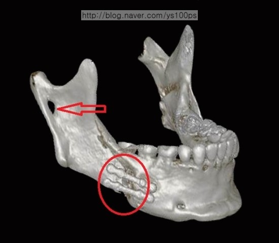 양악수술 후 턱끝 이차각과 금속 고정물 측면 X-ray