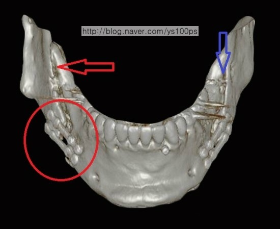양악수술 후 금속 고정물과 골 결손 정면 X-ray