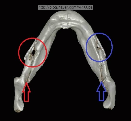 좌측 하악각 골 결손과 절골면 측면 3D CT