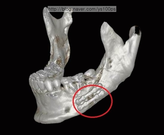 우측 하악골 절골면과 골 결손 사면 3D CT