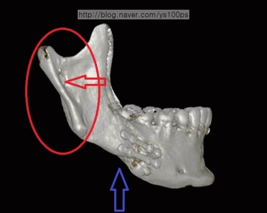 양악수술 후 양측 하악골 절골면 정면 3D CT