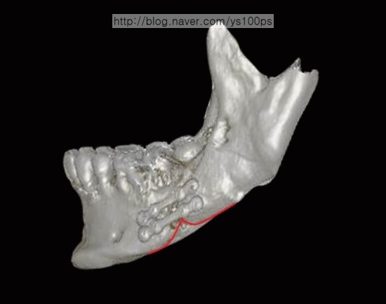 우측 하악각 골 결손과 불규칙한 절골면 측면 3D CT
