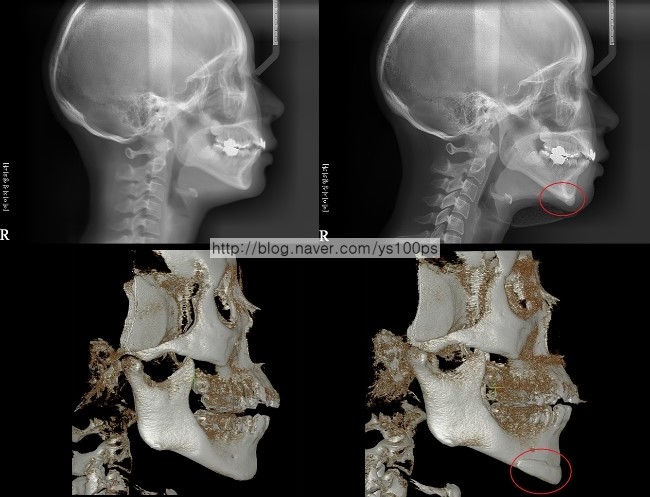 턱끝 길이연장 전후 측면 X-ray와 3D CT