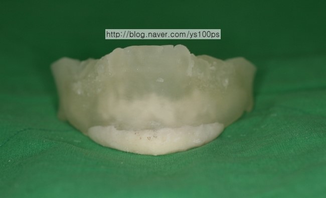 아래쪽 길이연장을 위해 제작한 3D Fit PMMA 보형물 정면