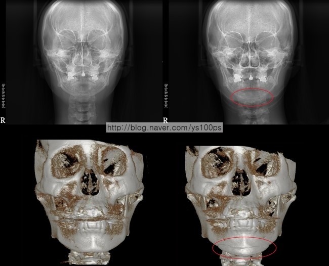 턱끝 길이연장 전후 정면 X-ray와 3D CT