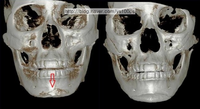 안면윤곽 재수술 전후 정면 3D CT 비교