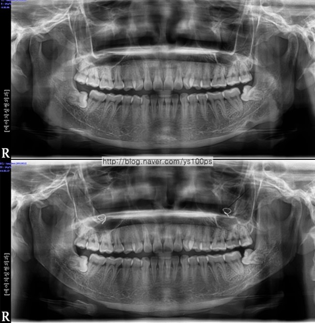 안면윤곽 재수술 전후 파노라마 X-ray 비교