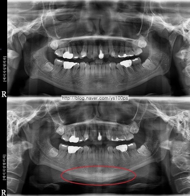 턱끝 길이연장 전후 파노라마 X-ray