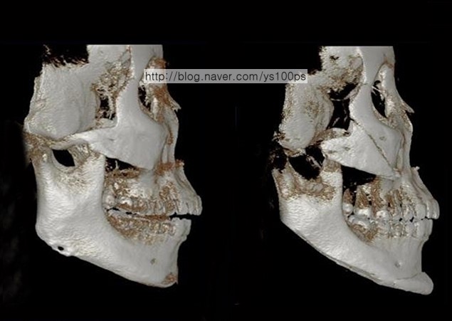 안면윤곽 재수술 후 우측 3D CT