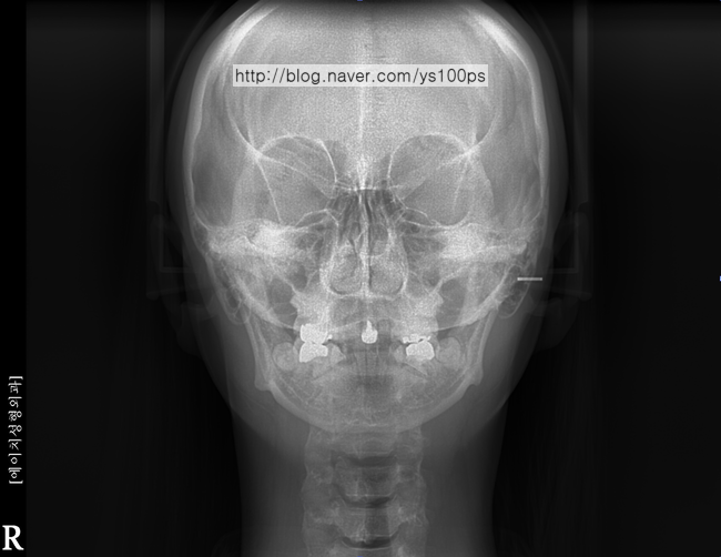 짧은 하악골과 턱끝을 보여주는 정면 X-ray
