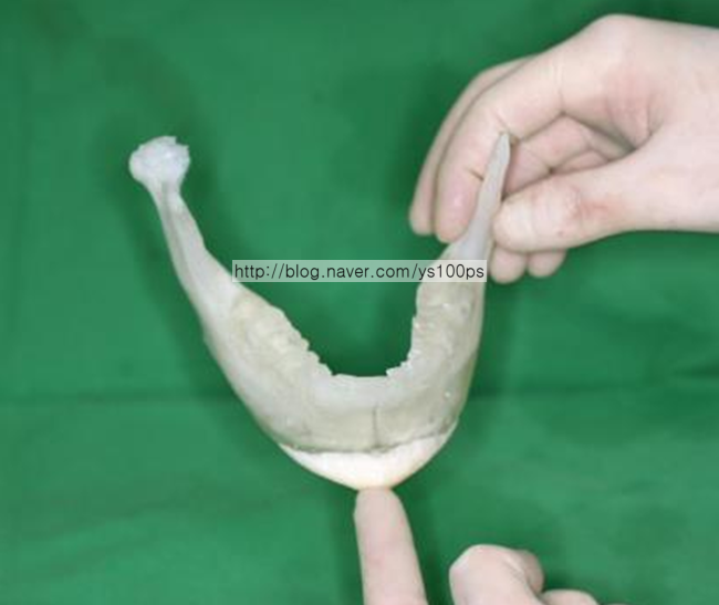 턱끝 재수술에 사용한 3D Fit PMMA 맞춤 보형물