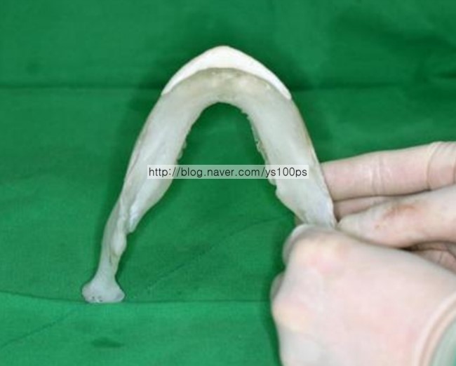턱끝 전진과 길이연장을 위한 3D Fit PMMA 보형물