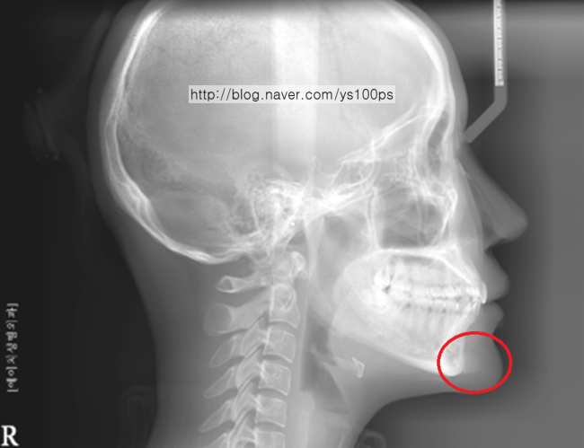 안면윤곽 재수술 전 턱끝 실리콘 보형물 측면 X-ray
